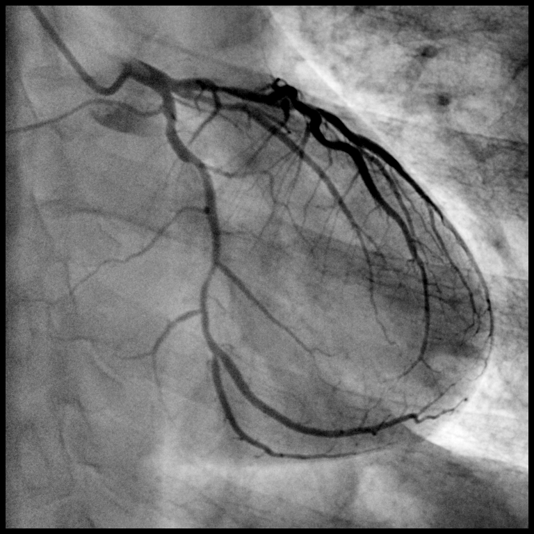 心脏冠脉.jpg